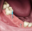  Implants offer a very stable and secure fit.