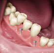 Implants serve as a base for single replacement of teeth