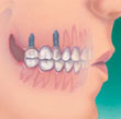  Implants serve as a base for single replacement of teeth